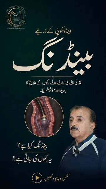 Banding for swollen food-pipe veins — video by Prof. Dr. Sherbat Khan